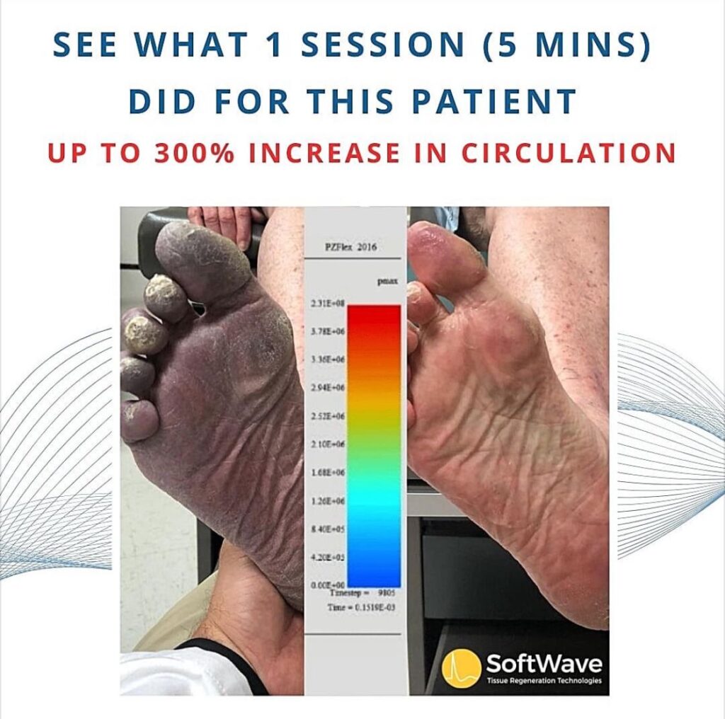 softwave-therapy-is-great-for-improving-circulation